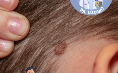 Cómo reconocer cáncer en un lunar